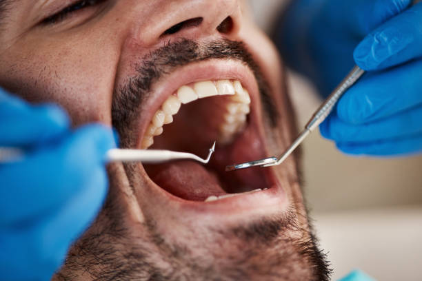 Best Emergency Dental Extractions in Parkland, WA